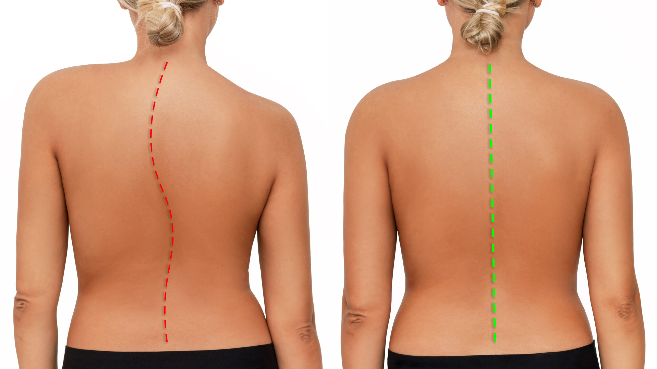 Scoliosis and Posture:اعوجاج العمود الفقري
